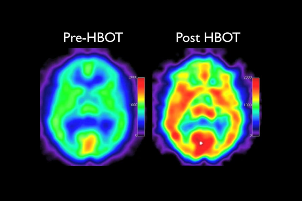 Pre post HBOT – absolutehealthocala
